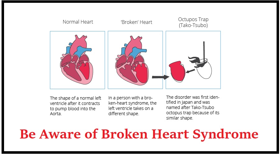 Be Aware of Broken Heart Syndrome