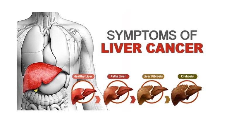 liver cancer symptoms