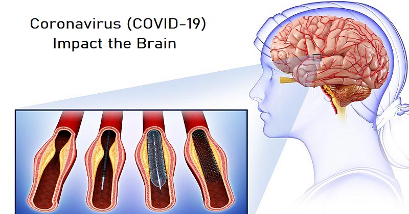 Coronavirus Could Impact the Brains