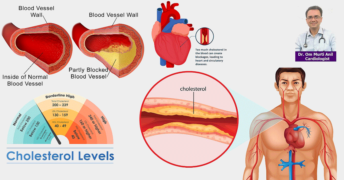 High cholesterol and triglycerides Risk and ways to Control